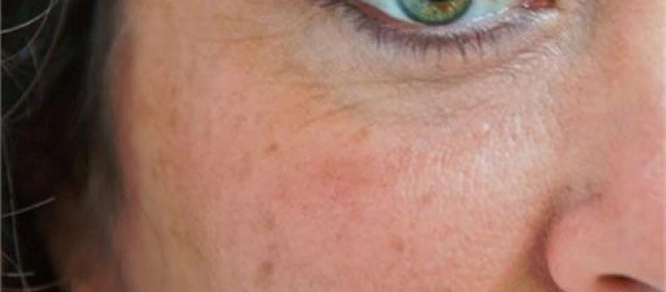 Καφέ κηλίδες στο δέρμα: Πως δημιουργούνται και τι να κάνετε για να τις προλάβετε πριν εμφανιστούν